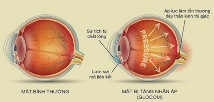 Bệnh glôcôm và những điều cần biết
